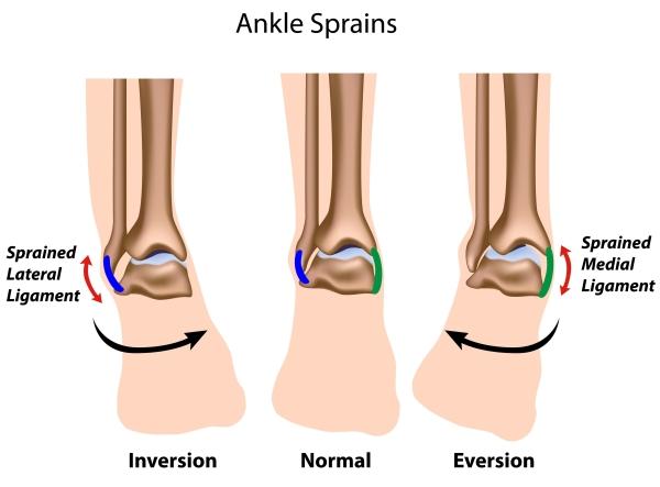 torn tendon in ankle symptoms